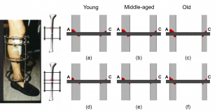 Bone yielding in fracture fixed using Ilizarov fixator for two different configurations and three different bone qualities.